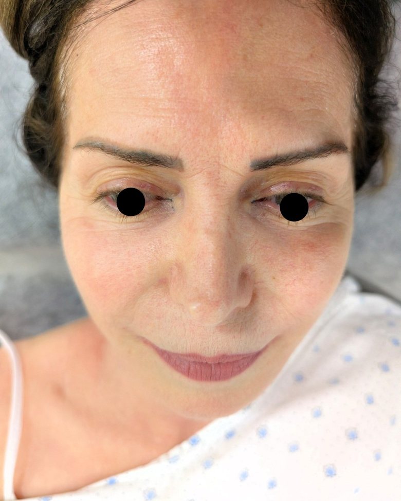 Upper blepharoplasty before, frontal