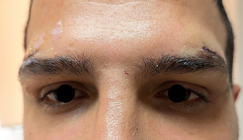 Direct brow lift patient after surgery, same visit, frontal view, Dr. Vincent ElKhoury, plastic surgeon in Mansourieh, Lebanon
