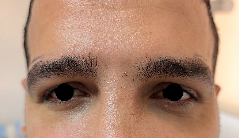 Direct brow lift patient before surgery, frontal view, Dr. Vincent ElKhoury, plastic surgeon in Mansourieh, Lebanon