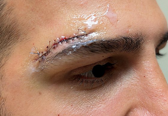 Direct brow lift patient minutes after surgery, sutures along the upper brow edge, three-quarter view, Dr. Vincent ElKhoury, plastic surgeon in Mansourieh, Lebanon