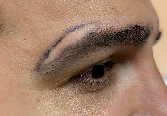 Direct brow lift patient before surgery with surgical marking, three-quarter view, Dr. Vincent ElKhoury, plastic surgeon in Mansourieh, Lebanon