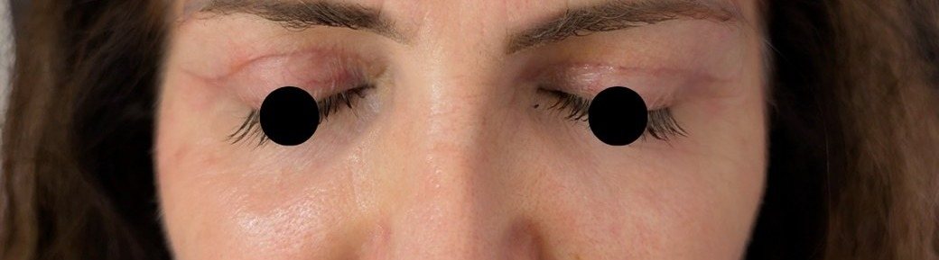 Close-up of upper lids after
