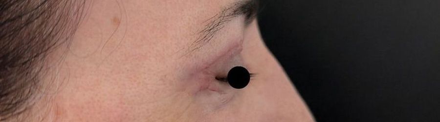 Close-up of the upper and lower lid in profile after surgery, Dr. Vincent ElKhoury, plastic surgeon in Mansourieh, Lebanon