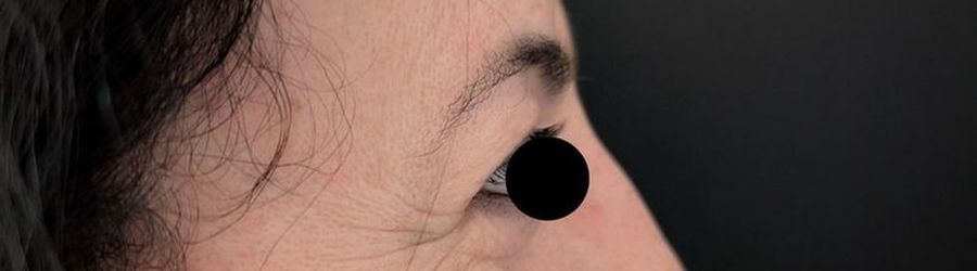 Close-up of the upper and lower lid in profile before surgery, Dr. Vincent ElKhoury, plastic surgeon in Mansourieh, Lebanon