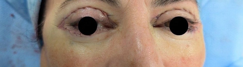 Close-up day of surgery