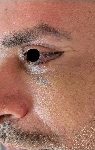 Upper and lower lids after