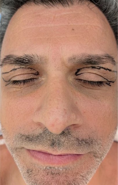 Upper and lower lids before