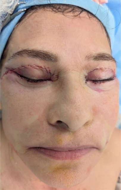 Upper and lower lids after