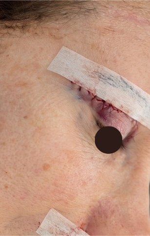 Upper lids after