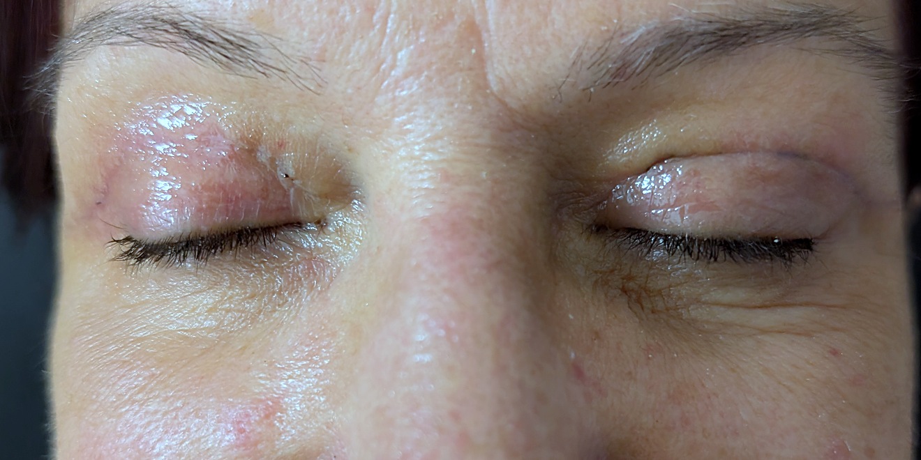 Upper lids closed sixteen days after surgery, incision healing in the crease