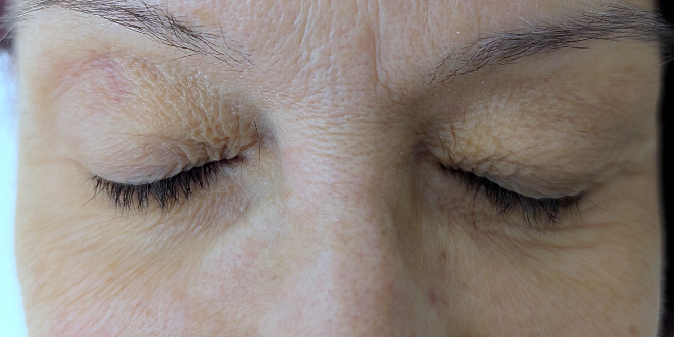 Upper lids closed before surgery, both eyes