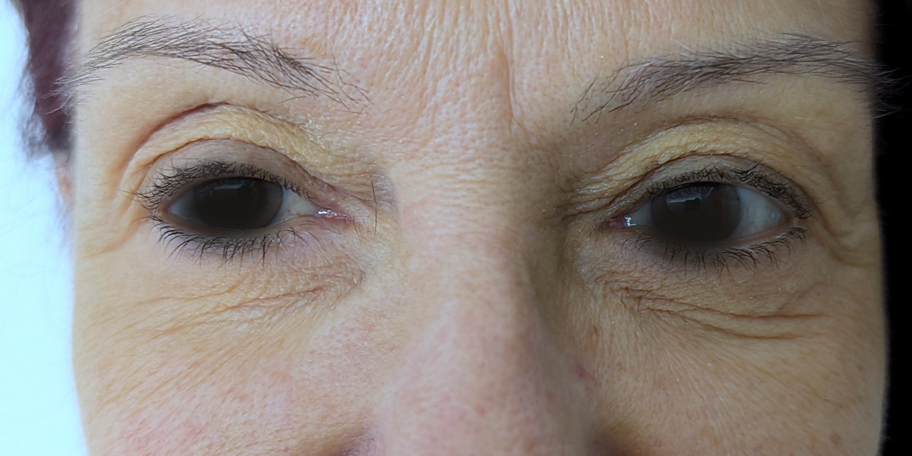 Upper blepharoplasty before surgery, both eyes, frontal