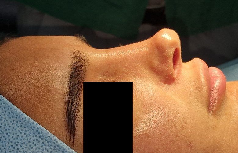 Rhinoplastie de reprise, voie ouverte — avant, Dr Vincent ElKhoury, chirurgien esthétique à Mansourieh, Liban
