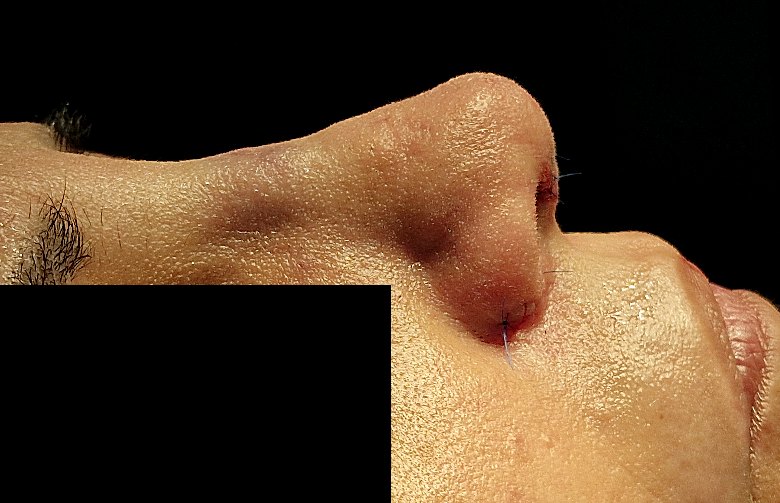 Open primary rhinoplasty patient after surgery, same visit, Dr. Vincent ElKhoury, plastic surgeon in Mansourieh, Lebanon