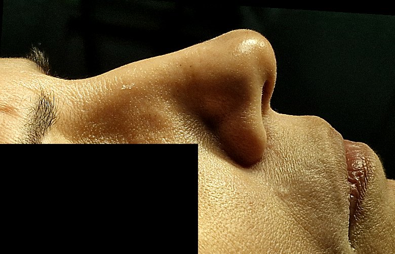 Open primary rhinoplasty patient before surgery, profile view, Dr. Vincent ElKhoury, plastic surgeon in Mansourieh, Lebanon
