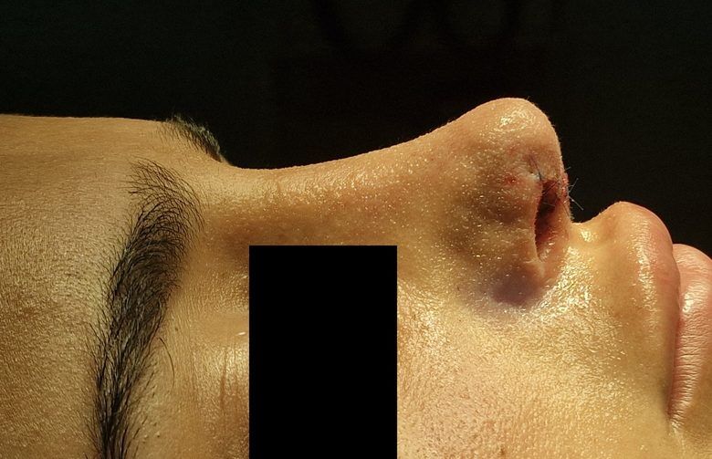 Open revision rhinoplasty patient after surgery, same visit, Dr. Vincent ElKhoury, plastic surgeon in Mansourieh, Lebanon