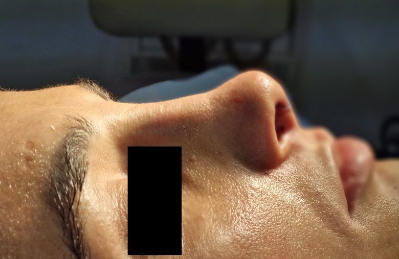 Open revision rhinoplasty patient after surgery, same visit, Dr. Vincent ElKhoury, plastic surgeon in Mansourieh, Lebanon