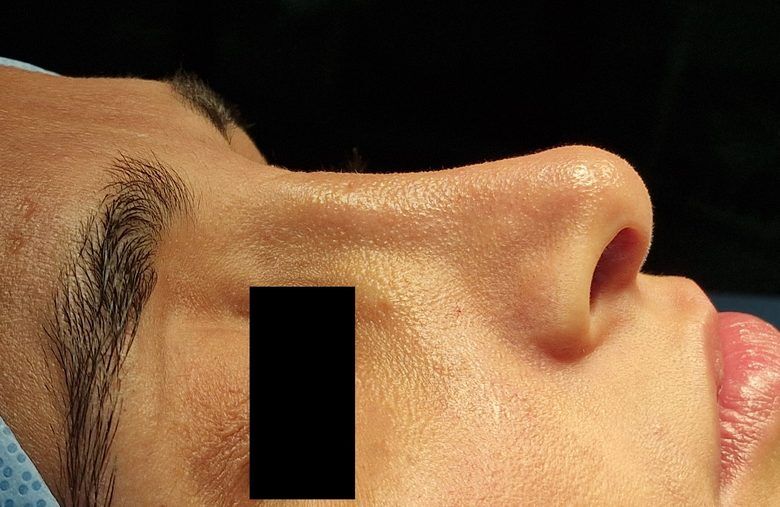Open revision rhinoplasty patient before surgery, profile view, Dr. Vincent ElKhoury, plastic surgeon in Mansourieh, Lebanon